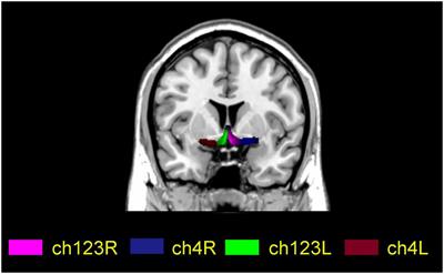 The increased effective connectivity from left middle occipital gyrus to right medial septum/diagonal bands in AD patients after donepezil intervention
